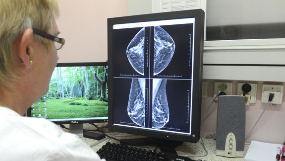 Medzi ženami do 50 rokov výrazne pribúda prípadov rakoviny prsníka, najhoršia situácia je v Bratislave