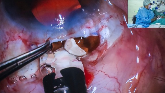 Úžasné: Lekári z UNB dokážu prinavrátiť zrak vďaka implantovaniu teleskopu do oka