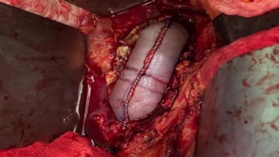 Unikátna operácia v UNB: Pacientovi časť brušnej dutiny nahradili protézou z hovädzieho osrdcovníka.