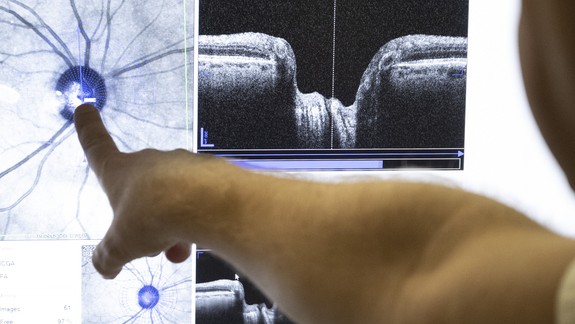 Radíme: Pravidelné očné prehliadky sú jedinou prevenciou rozvoja zeleného zákalu