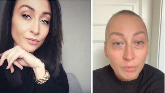 Katka statočne zvádza tvrdý boj s rakovinou: Poisťovňa jej však odmietla preplatiť liečbu