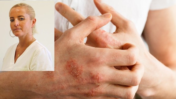 Zdravie: Na vzniku psoriázy sa podieľa genetika, stres aj životný štýl - ako sa dá liečiť?