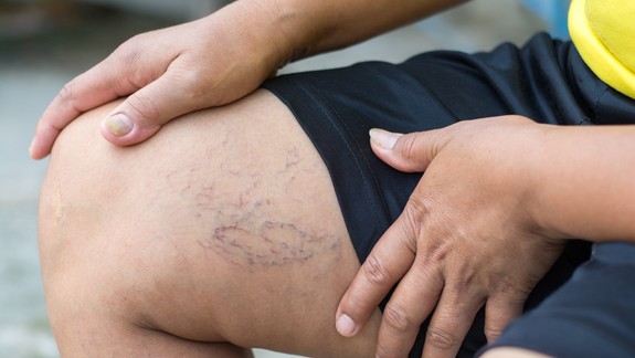 Radíme: Kŕčové žily sú spôsobené zlým prúdením krvi, vedú k bolestiam aj opuchu