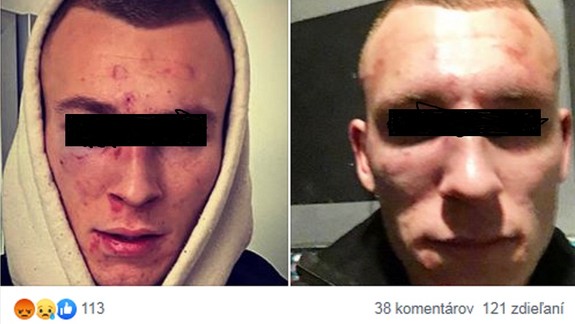 Hrozné. Ďalšia bitka na Námestí SNP, obeť má zlomený nos a ďalšie zranenia