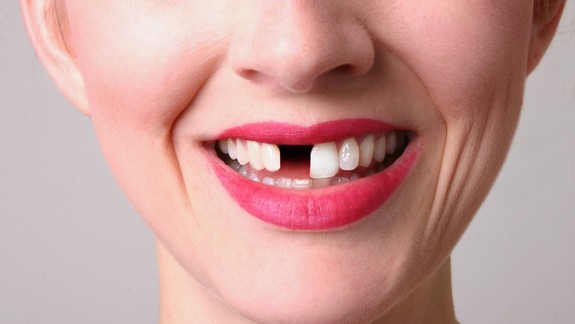 RADÍME: Nepodceňujte parodontitídu, môže vás to stáť zuby