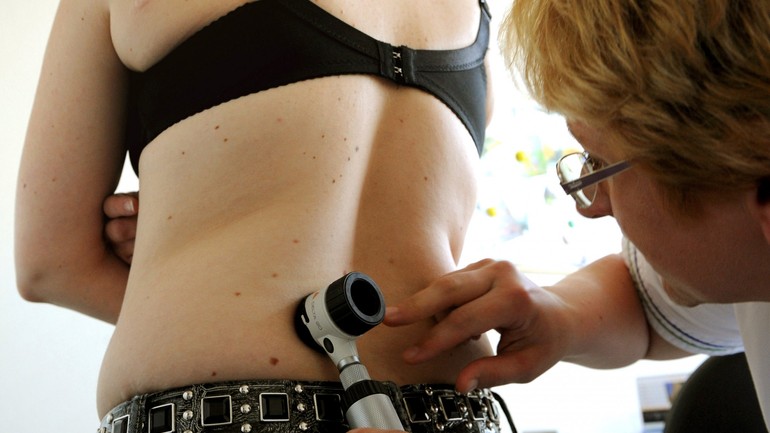 Melanóm - vyšetrenie u dermatológa